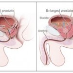 Comparison of normal and hyperplastic prostate
