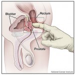 Digital Rectal Exam